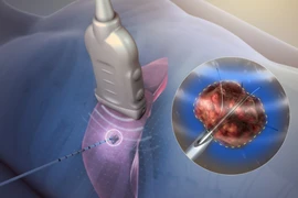 Kỹ thuật đốt sóng cao tần trong điều trị ung thư gan, khi nào nên chọn?