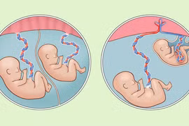 Cứu trẻ song thai sinh non nặng chưa đến 1 kg viêm ruột hoại tử nặng 