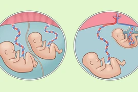 Cứu trẻ song thai sinh non nặng chưa đến 1 kg viêm ruột hoại tử nặng 