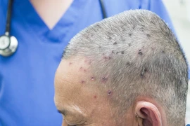 Người đàn ông 61 tuổi sốc phản vệ nặng do bị ong đốt 117 mũi