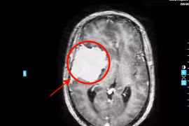 Đau đầu tưởng rối loạn tiền đình, nào ngờ khối u “khổng lồ” ăn mòn xương sọ