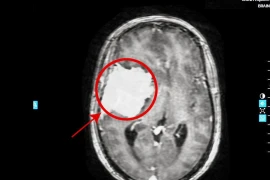 Đau đầu tưởng rối loạn tiền đình, nào ngờ khối u “khổng lồ” ăn mòn xương sọ