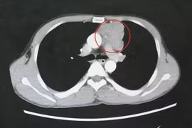 Tìm lại hy vọng sống cho thanh niên 39 tuổi hôn mê, co giật do nhược cơ