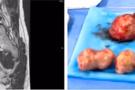 Đau bụng, ra máu âm đạo, bệnh nhân phát hiện đa u xơ tử cung phức tạp