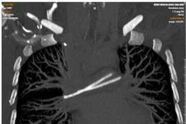 Thoát hiểm từ “dị vật trong tim”