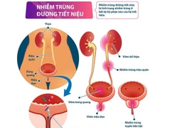 Nhiễm khuẩn tiết niệu, dấu hiệu nhỏ hậu quả lớn