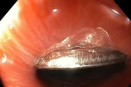 Chơi đùa, bé trai 5 tuổi vô tình nuốt phải đồng xu vào thực quản