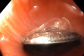 Chơi đùa, bé trai 5 tuổi vô tình nuốt phải đồng xu vào thực quản