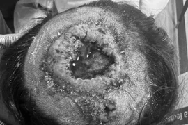 Đắp lá táo trị tổn thương da đầu, trẻ bị loét hoại tử sâu rộng