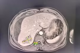 Bụng chướng căng người bệnh nguy kịch do áp xe gan vỡ chảy máu ổ bụng