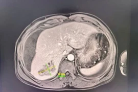 Bụng chướng căng người bệnh nguy kịch do áp xe gan vỡ chảy máu ổ bụng