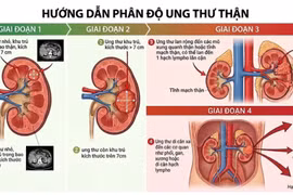 Đau lưng kéo dài, người đàn ông 45 tuổi phát hiện ung thư thận