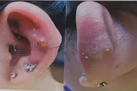 Bé gái nhập viện vì khuyên tai tụt sâu vào bên trong