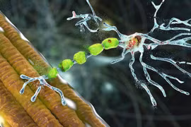 Yếu cơ co giật không rõ nguyên nhân do bệnh xơ cột bên teo cơ