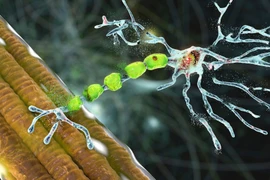 Yếu cơ co giật không rõ nguyên nhân do bệnh xơ cột bên teo cơ