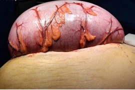 Bụng phình to, mổ cấp cứu trong đêm cắt hơn 0,5 m ruột do xoắn