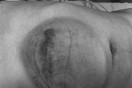 Chủ quan không đi khám u thành bụng tái phát đường kính 20cm