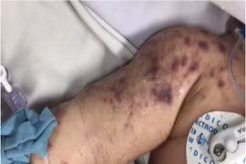 Một bệnh nhi tử vong do viêm não mô cầu nhóm B, bác sĩ cảnh báo