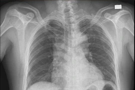 Đau ngực như dao đâm, người đàn ông bị lóc tách động mạch chủ nguy kịch