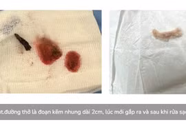 Kịp thời cứu trẻ 3 tuổi nuốt đoạn kẽm nhung dài 2cm