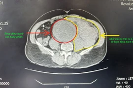 Báo động đỏ cứu người bệnh vỡ phình động mạch chủ bụng