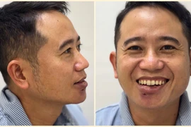 Nặn mụn nhỏ phải nhập viện vì tổn thương lớn do vi khuẩn đa kháng thuốc