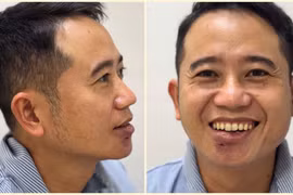 Nặn mụn nhỏ phải nhập viện vì tổn thương lớn do vi khuẩn đa kháng thuốc