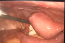 Nhiều người già tắc ruột do bã thức ăn, biến chứng vỡ ruột, hoại tử