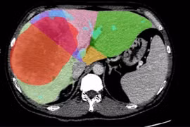 Đau tức vùng bụng, phát hiện u gan khổng lồ 18,6 cm, phải cắt 2 lần mới hết