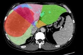 Đau tức vùng bụng, phát hiện u gan khổng lồ 18,6 cm, phải cắt 2 lần mới hết