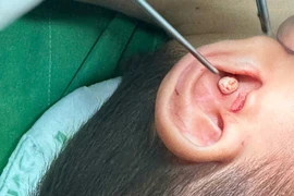 Gây mê lấy sỏi trong tai trẻ hơn 5 tuổi