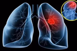 16-20% ung thư phổi phát triển di căn não, cách gì phát hiện sớm?