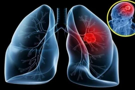 16-20% ung thư phổi phát triển di căn não, cách gì phát hiện sớm?