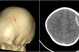 Bé 3 tuổi bị tụ máu não sau ngã, cảnh báo tai nạn sinh hoạt ở trẻ nhỏ