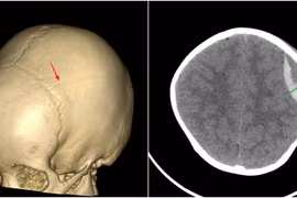 Bé 3 tuổi bị tụ máu não sau ngã, cảnh báo tai nạn sinh hoạt ở trẻ nhỏ
