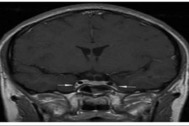 'Tử thần' mang tên viêm tắc tĩnh mạch xoang hang, dấu hiệu không nên bỏ qua