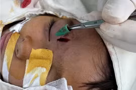 Dị vật hố mắt bỏ sót sau chấn thương ở trẻ em