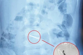 Hành trình cứu bé trai nuốt nhiều viên nam châm gây thủng ruột