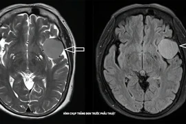 Phẫu thuật thành công u màng não lớn cho cụ bà 73 tuổi 