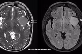Phẫu thuật thành công u màng não lớn cho cụ bà 73 tuổi 