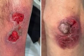 Tổn thương gan thận, thần kinh vì ngộ độc thuốc methotrexate