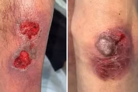 Tổn thương gan thận, thần kinh vì ngộ độc thuốc methotrexate