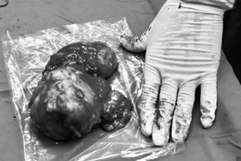 Đau mông đi khám phát hiện 2 khối u mỡ khổng lồ