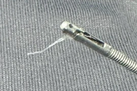 Gắp thành công dị vật xương cá cho bé trai 6 tuổi