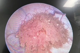 Không có biểu hiện, du học sinh Hàn Quốc phát hiện u bàng quang