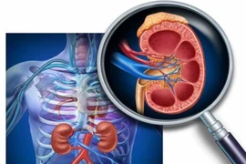 Viêm cầu thận có di truyền không?