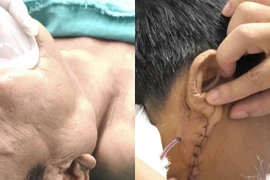 Cẩn thận u tuyến nước bọt tái phát gây liệt mặt, mù, chuyển ung thư