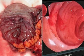 Hành trình cứu sống một ca xuất huyết ruột non nguy kịch