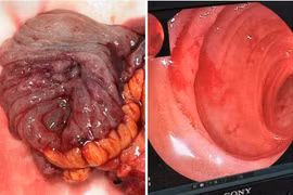 Hành trình cứu sống một ca xuất huyết ruột non nguy kịch