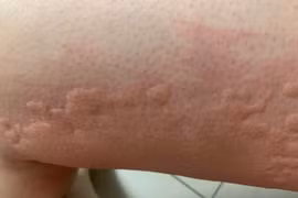 Mày đay cấp bùng phát mùa Tết, đừng chủ quan những mảng đỏ 'nở rộ' trên da